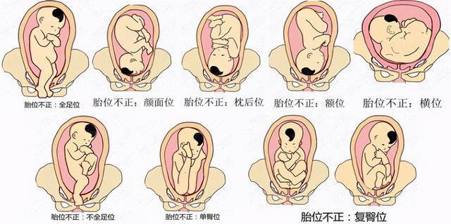 寶寶胎位不正你會(huì)看嗎？