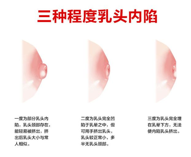 乳頭凹陷的媽媽該如何哺乳？