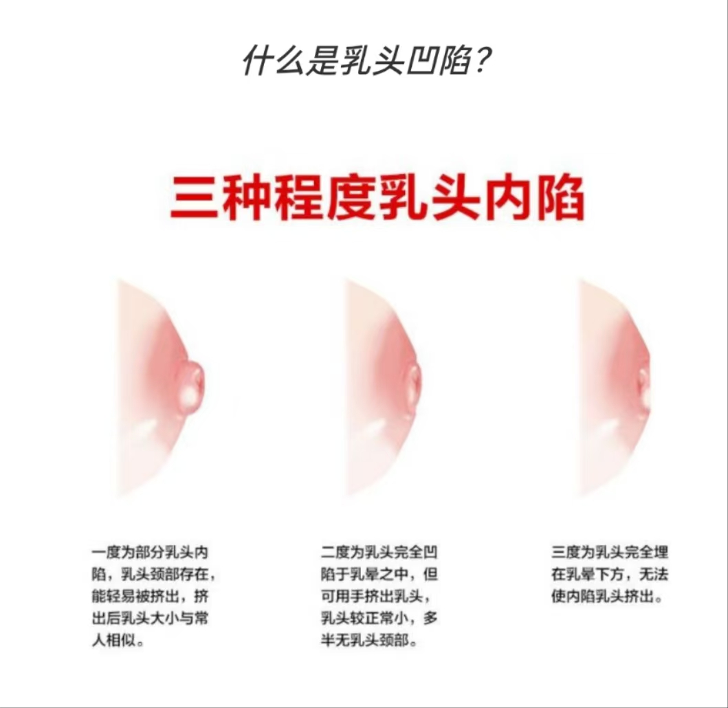 乳頭凹陷的媽媽該如何哺乳？